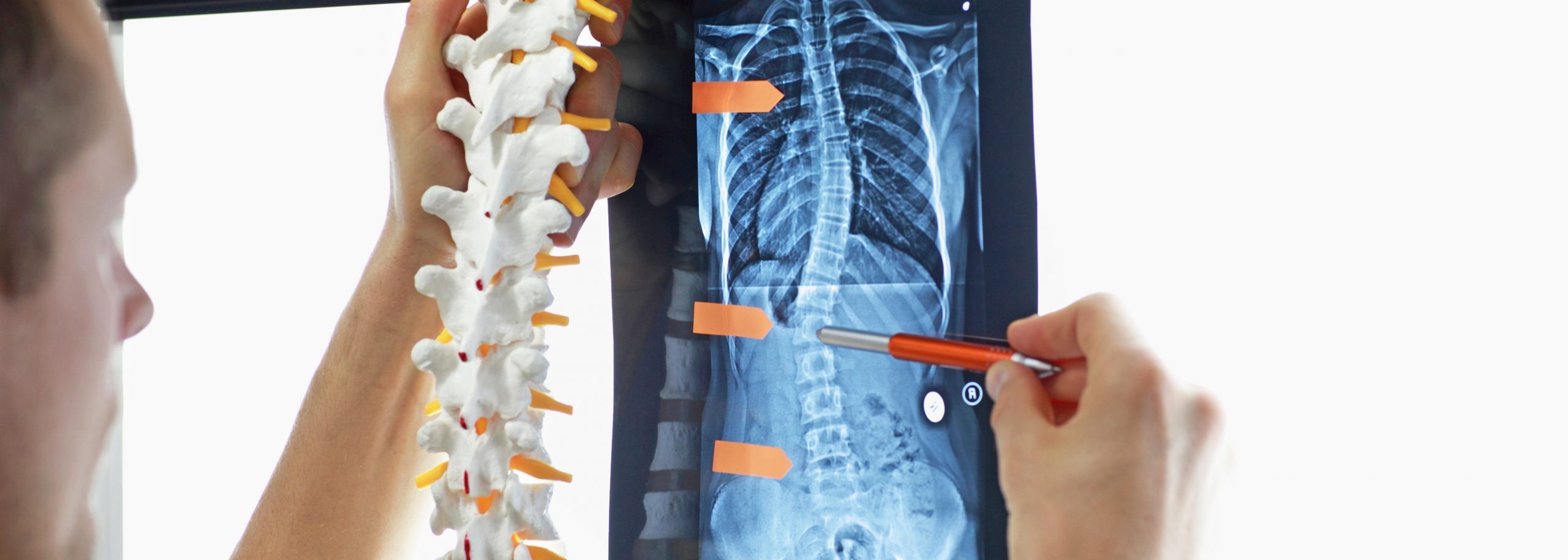 Skoliose Diagnose eines Orthopäden mittels Modell der Wirbelsäule und MRT-/Röntgenbild