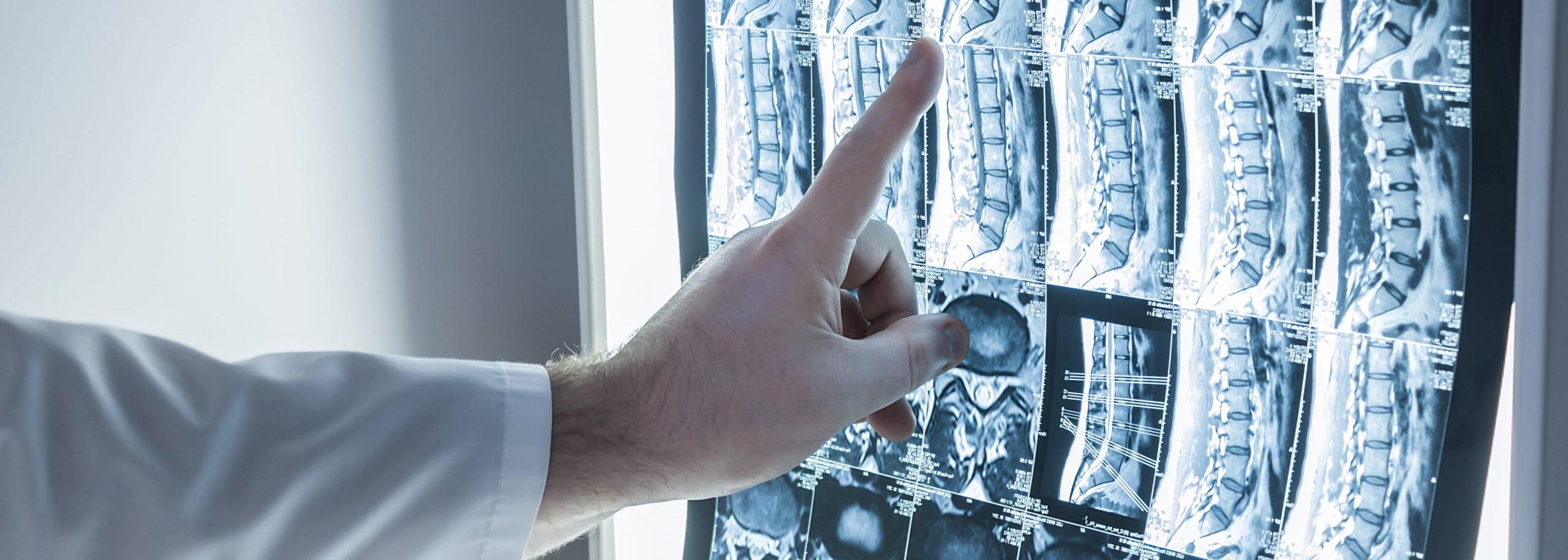 Operateur zeigt auf Röntgenbild der Lendenwirbelsäule