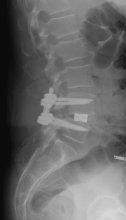Röntgenbild eines stabilisierten und reponierten Gleitwirbels mit Schrauben-Stab-System (Spondylodese)